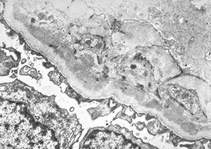 type I membranoproliferative glomerulonephritis